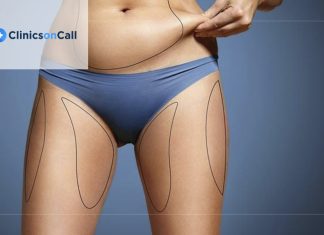 Новейшие технологии липосакции в Турции